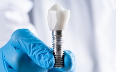 Dental Implants in Vancouver: What They Cost, How Long They Take, and Whether You’re a Candidate