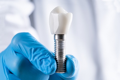 Dental Implants in Vancouver: What They Cost, How Long They Take, and Whether You’re a Candidate